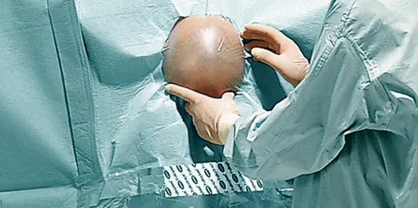 Foliodrape PPlus Neurochirurgie Set I P6