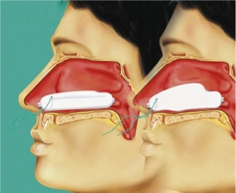 Raucocel Nasentamponade anatomisch 80mm, 10 Stk., steril, mit Faden, vent.